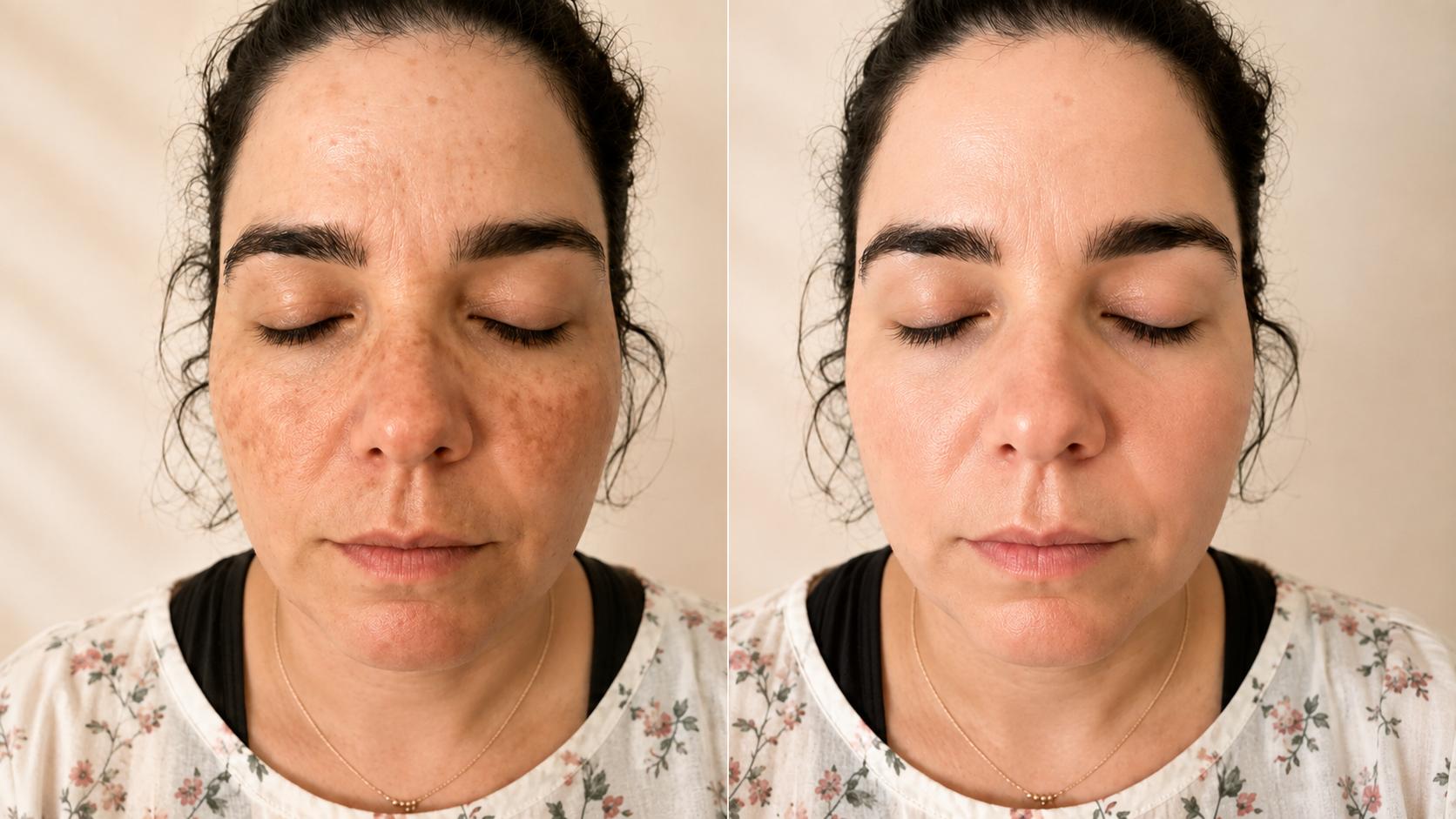 Comparación visual de un rostro con manchas antes y un tono más uniforme después